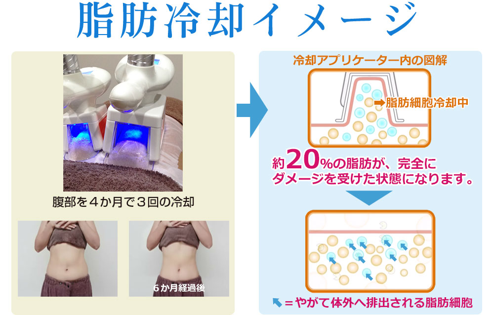 脂肪冷却のイメージ図